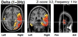 Delta wave brain scan before neurofeedback therapy